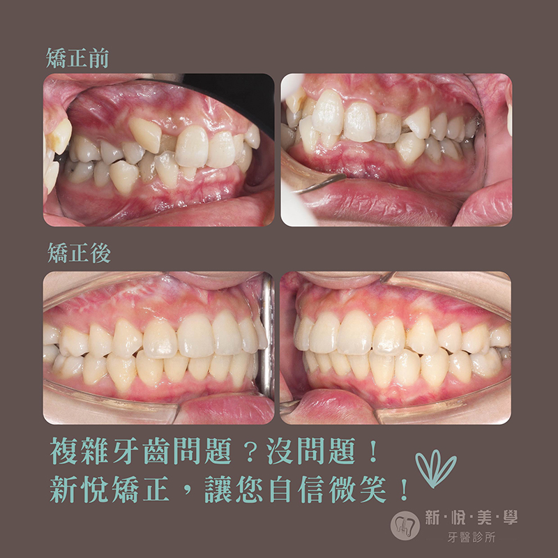 牙齒亂糟糟 ! 困難案例 !新悅不放棄的第3張圖片